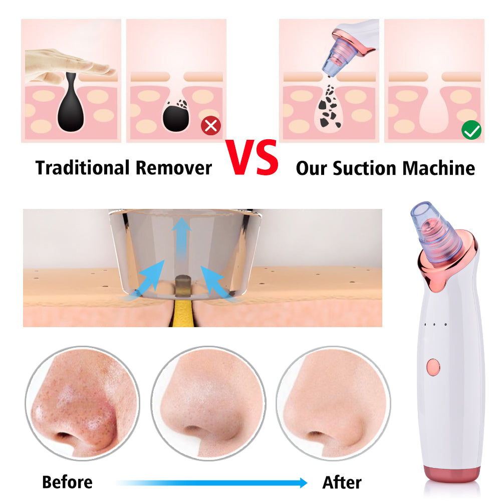 4-in-1 Blackhead Remover & Pore Vacuum Cleaner | Deep Cleansing with Multiple Probes | Cordless & Portable