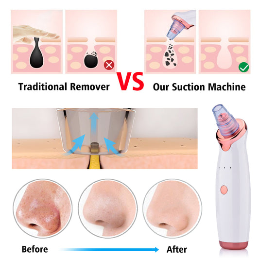 4-in-1 Blackhead Remover & Pore Vacuum Cleaner | Deep Cleansing with Multiple Probes | Cordless & Portable